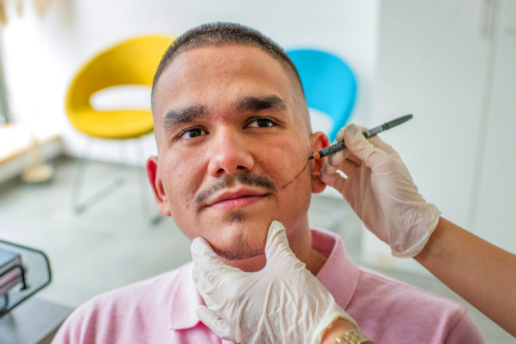 Beard Transplant Mexico